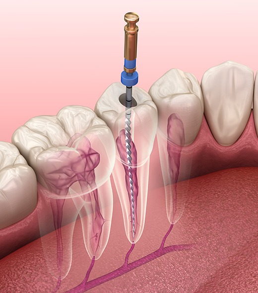 3D model of a root canal