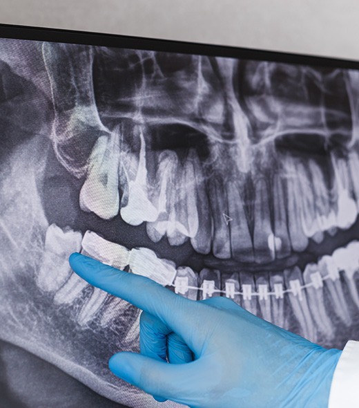 Dentist pointing to wisdom tooth on X-ray